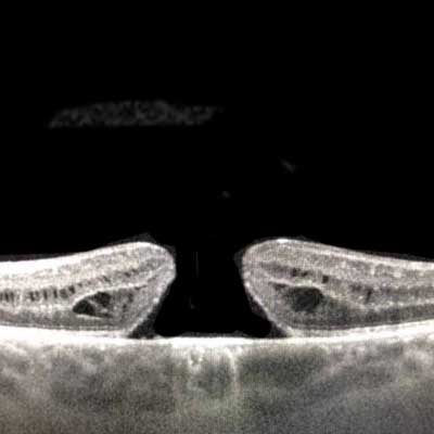 Agujero macular. Enfermedades y tratamientos para los problemas oculares por el Instituto Oftalmológico Recoletas.
