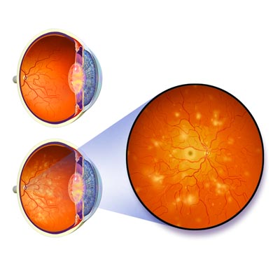 Retinopatía Diabética. Enfermedades y tratamientos para los problemas oculares por el Instituto Oftalmológico Recoletas.
