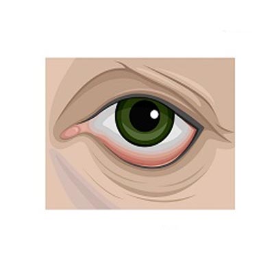 Ectropión. Enfermedades y tratamientos para los problemas oculares por el Instituto Oftalmológico Recoletas.