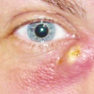 Obstrucción de la vía lagrimal. Enfermedades y tratamientos para los problemas oculares por el Instituto Oftalmológico Recoletas.
