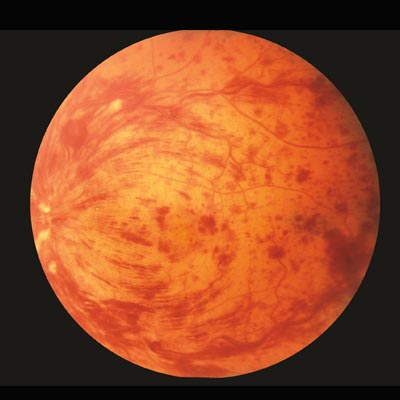 Oclusiones venosas de la retina. Enfermedades y tratamientos para los problemas oculares por el Instituto Oftalmológico Recoletas.