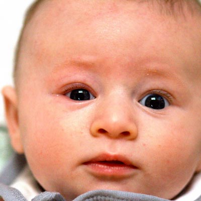 Ptosis Palpebral Infantil. Enfermedades y tratamientos para los problemas oculares por el Instituto Oftalmológico Recoletas.