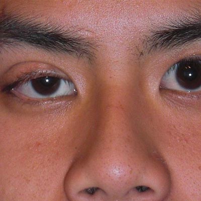Ptosis palpebral. Enfermedades y tratamientos para los problemas oculares por el Instituto Oftalmológico Recoletas.