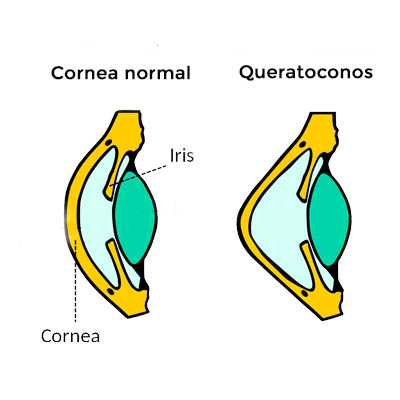 Queratocono. Enfermedades y tratamientos para los problemas oculares por el Instituto Oftalmológico Recoletas. 