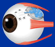  Válvulas para glaucoma. Enfermedades y tratamientos para los problemas oculares por el Instituto Oftalmológico Recoletas.
