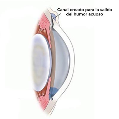Trabeculectomía. Enfermedades y tratamientos para los problemas oculares por el Instituto Oftalmológico Recoletas.