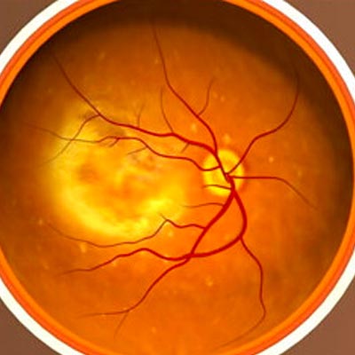 Degeneración Macular Asociada a la Edad. Enfermedades y tratamientos para los problemas oculares por el Instituto Oftalmológico Recoletas.