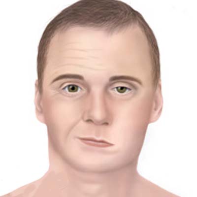 Parálisis Facial. Enfermedades y tratamientos para los problemas oculares por el Instituto Oftalmológico Recoletas.