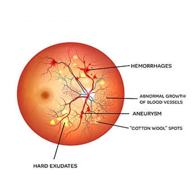 Retinopatía Diabética. Enfermedades y tratamientos para los problemas oculares por el Instituto Oftalmológico Recoletas.