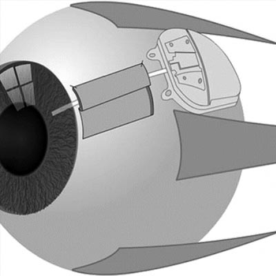  Válvulas para glaucoma. Enfermedades y tratamientos para los problemas oculares por el Instituto Oftalmológico Recoletas.