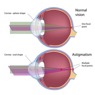 Agujero macular IOR Instituto oftalmológico