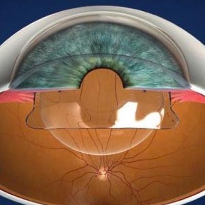 Agujero macular IOR Instituto oftalmológico