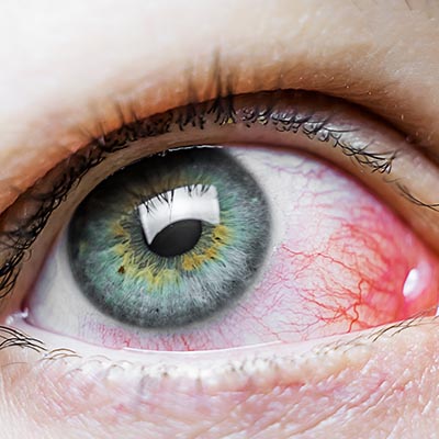 Agujero macular IOR Instituto oftalmológico