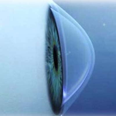 Agujero macular IOR Instituto oftalmológico