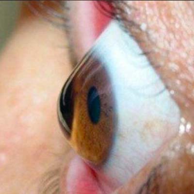 Agujero macular IOR Instituto oftalmológico