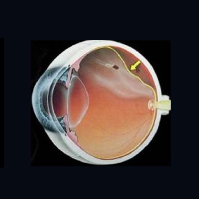 Agujero macular IOR Instituto oftalmológico