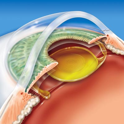 Agujero macular IOR Instituto oftalmológico