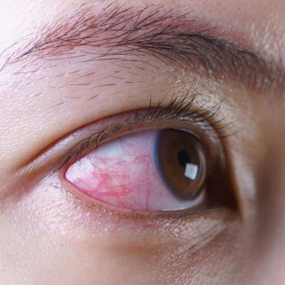 Uveítis anterior. Enfermedades y tratamientos oculares que se tratan en el Instituto Oftalmológico Recoletas.
