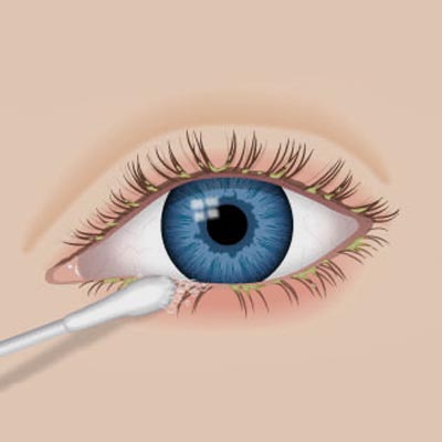 Blefaritis. Enfermedades y tratamientos oculares relativos a la conjuntivitis que se tratan en el Instituto Oftalmológico Recoletas