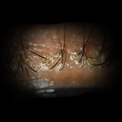 Blefaritis. Enfermedades y tratamientos oculares relativos a la conjuntivitis que se tratan en el Instituto Oftalmológico Recoletas