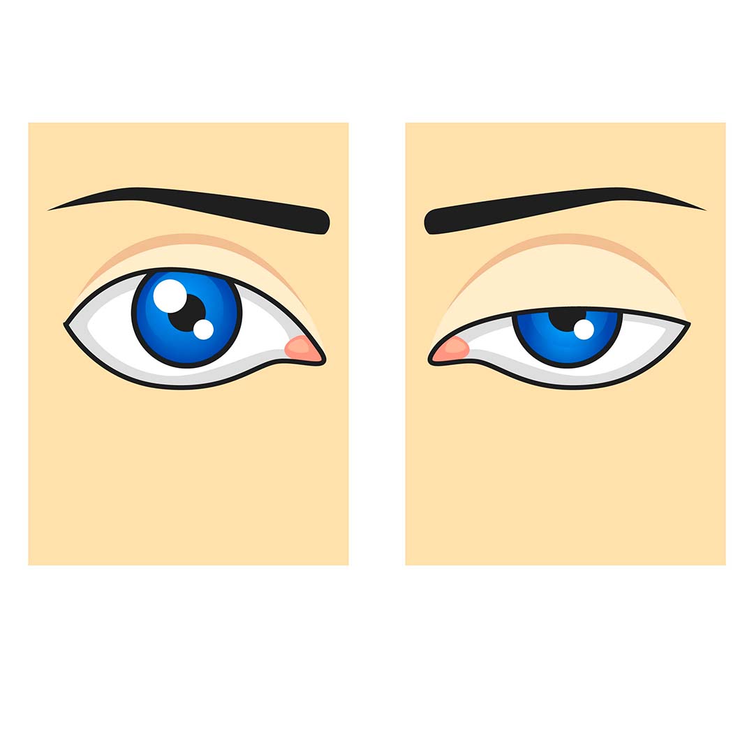 Ptosis Palpebral
