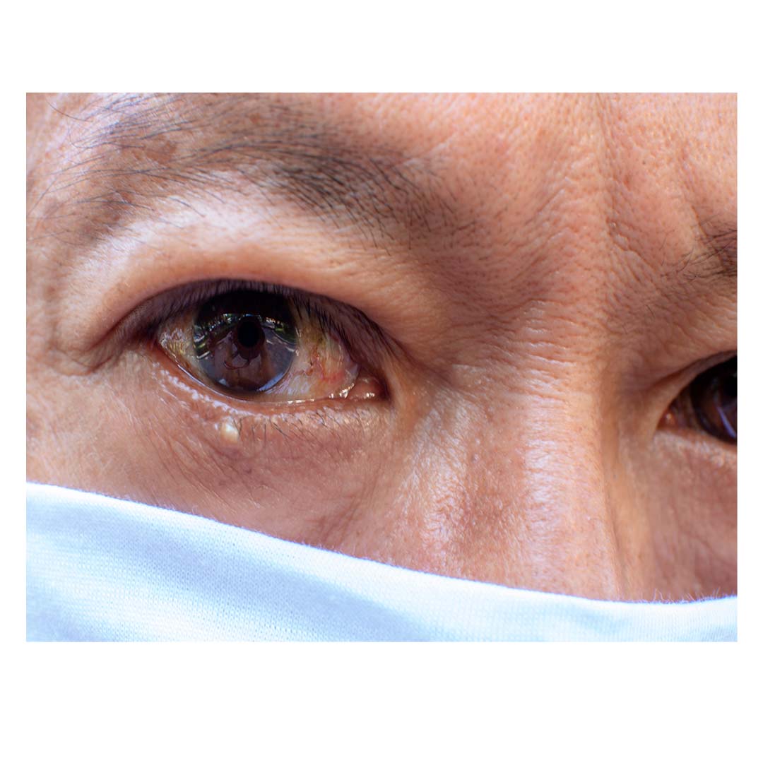 Tumor palpebral