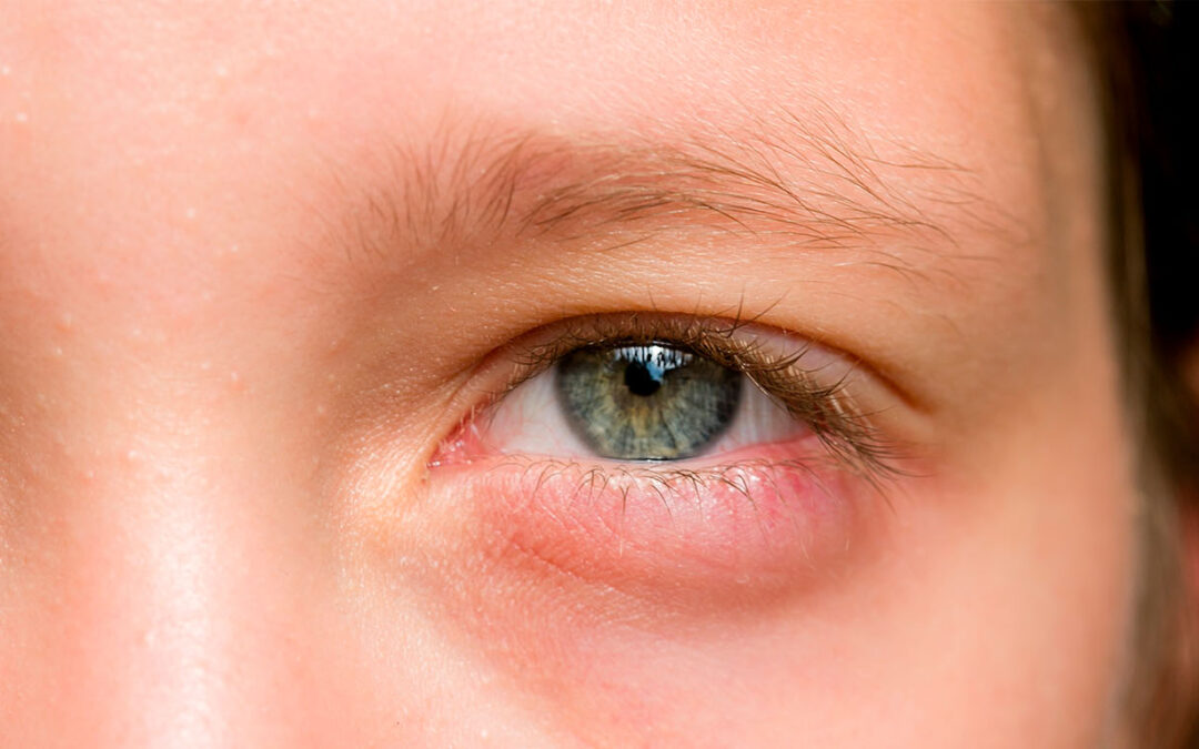 Celulitis Orbitraria: ¿qué es?