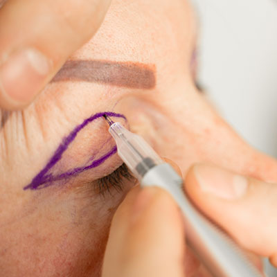blefaroplastia. Instituto Oftalmológico Recoletas