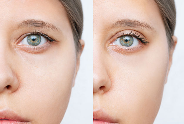 blefaroplastia. Instituto Oftalmológico Recoletas