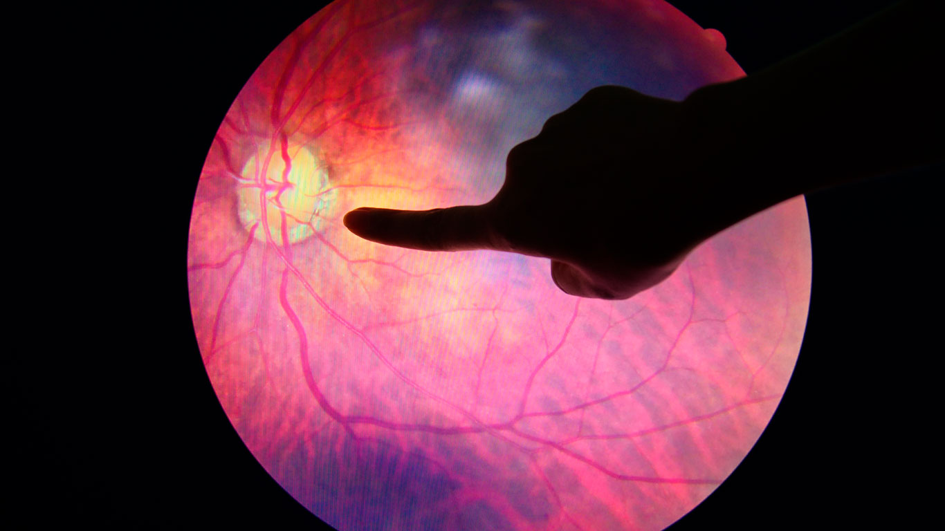 Retinopatía diabética ¿Qué sabes?