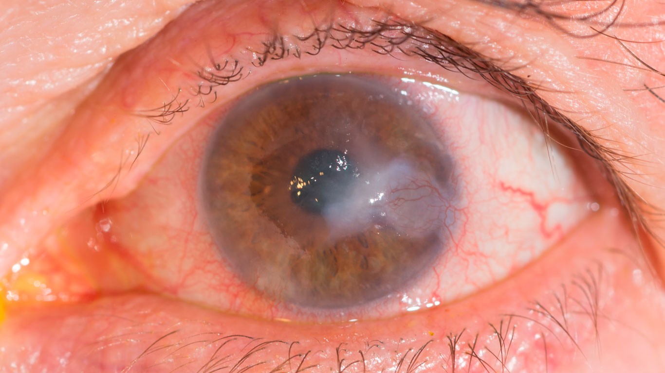 Queratitis fúngica ¿Qué es?