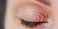 Tumores oculares